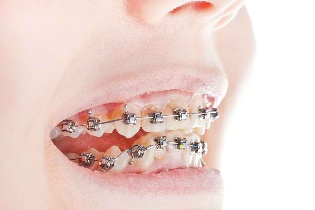 Penyebab Gigi  Tumbuh Tidak  Rata  dan Cara Merapikannya 